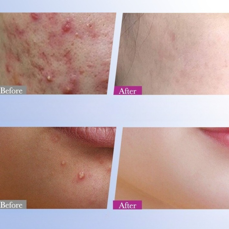 7/10/14Pcs Colorful Star Acne  - Skincare Qv reseña y precio