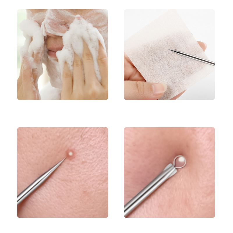 4pcs/set Acne Removal Needles  - Skincare Qv reseña y precio