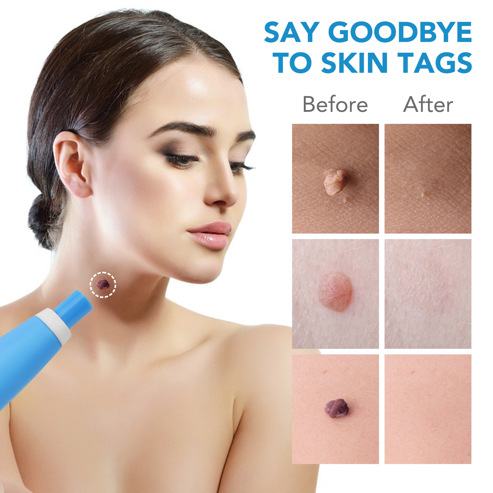 2 IN 1 Auto Skin Tag Remover K - Skincare Qv reseña y precio